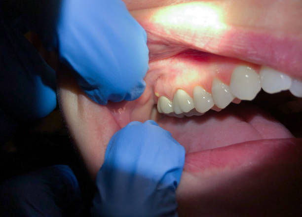 Best Emergency Tooth Extraction in Raubsville, PA